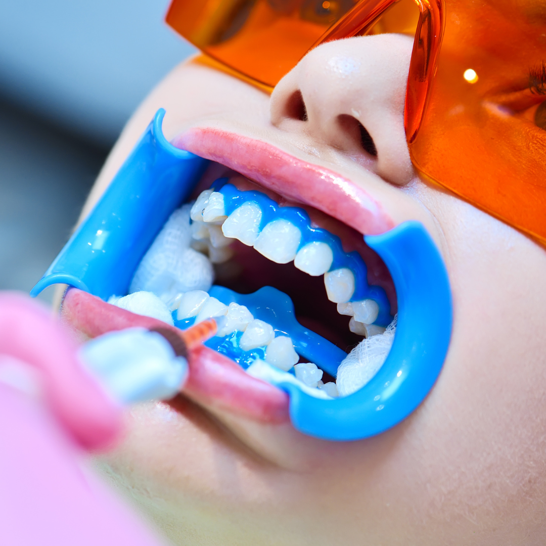 Dermatologia em João Pessoa - Clareamento Dental